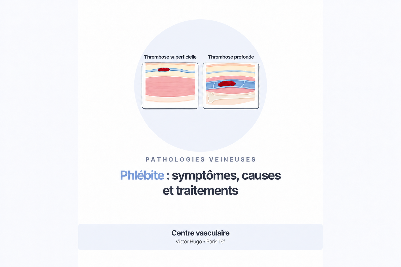 Vignette article phlébite : symptômes, causes et traitements. Thrombose superficielle et profonde