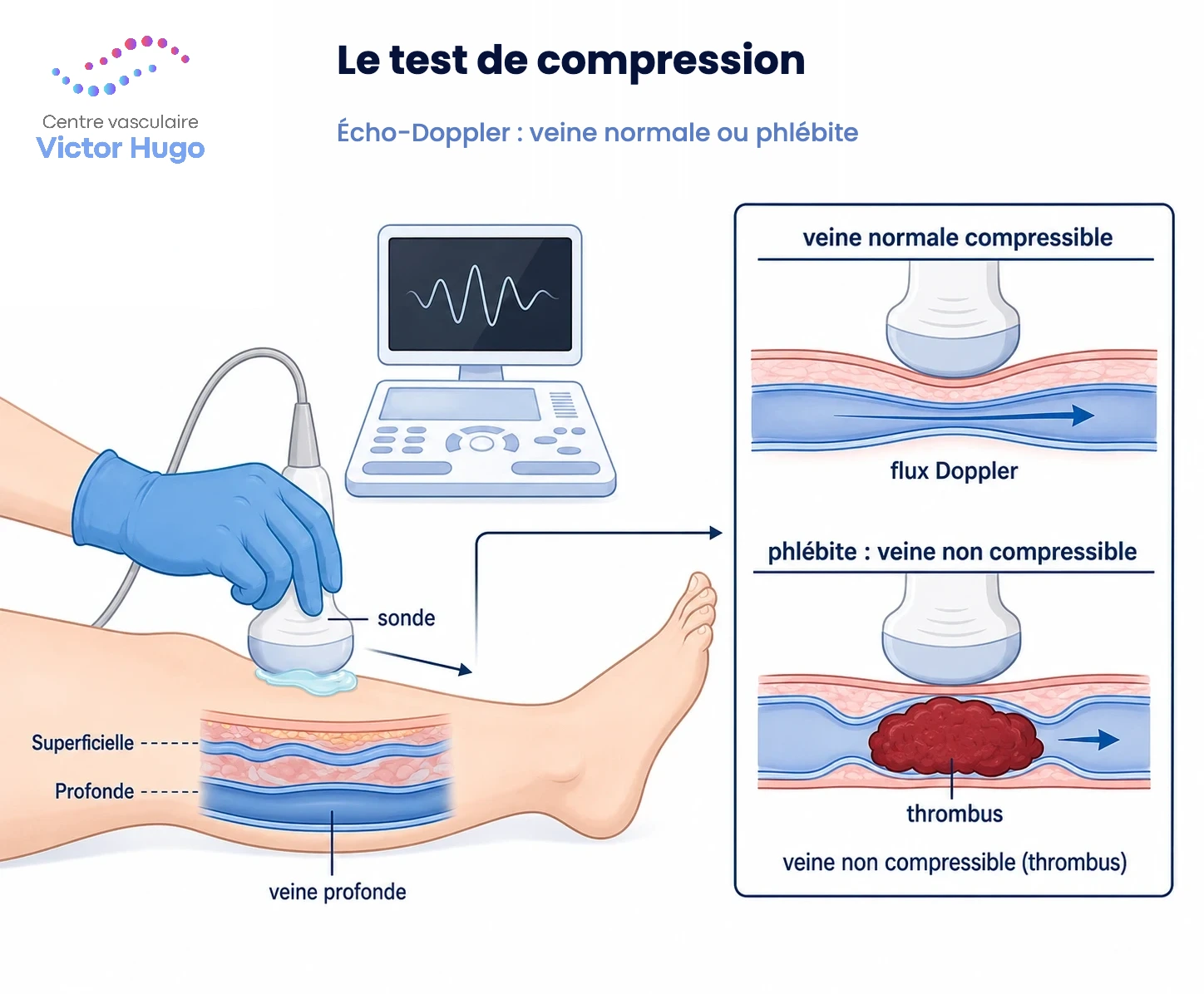 Test de compression veineuse réalisé lors d'un écho-Doppler pour diagnostiquer une phlébite
