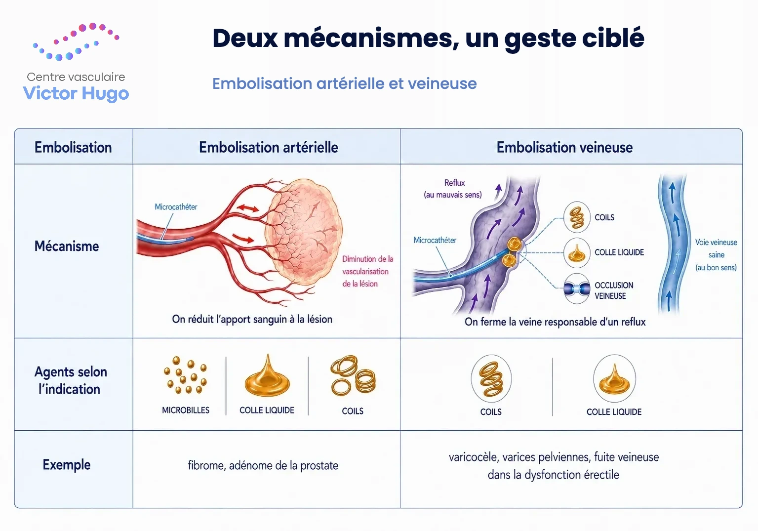 Schéma comparant l'embolisation artérielle, qui prive une lésion de son apport sanguin, et l'embolisation veineuse, qui stoppe un reflux