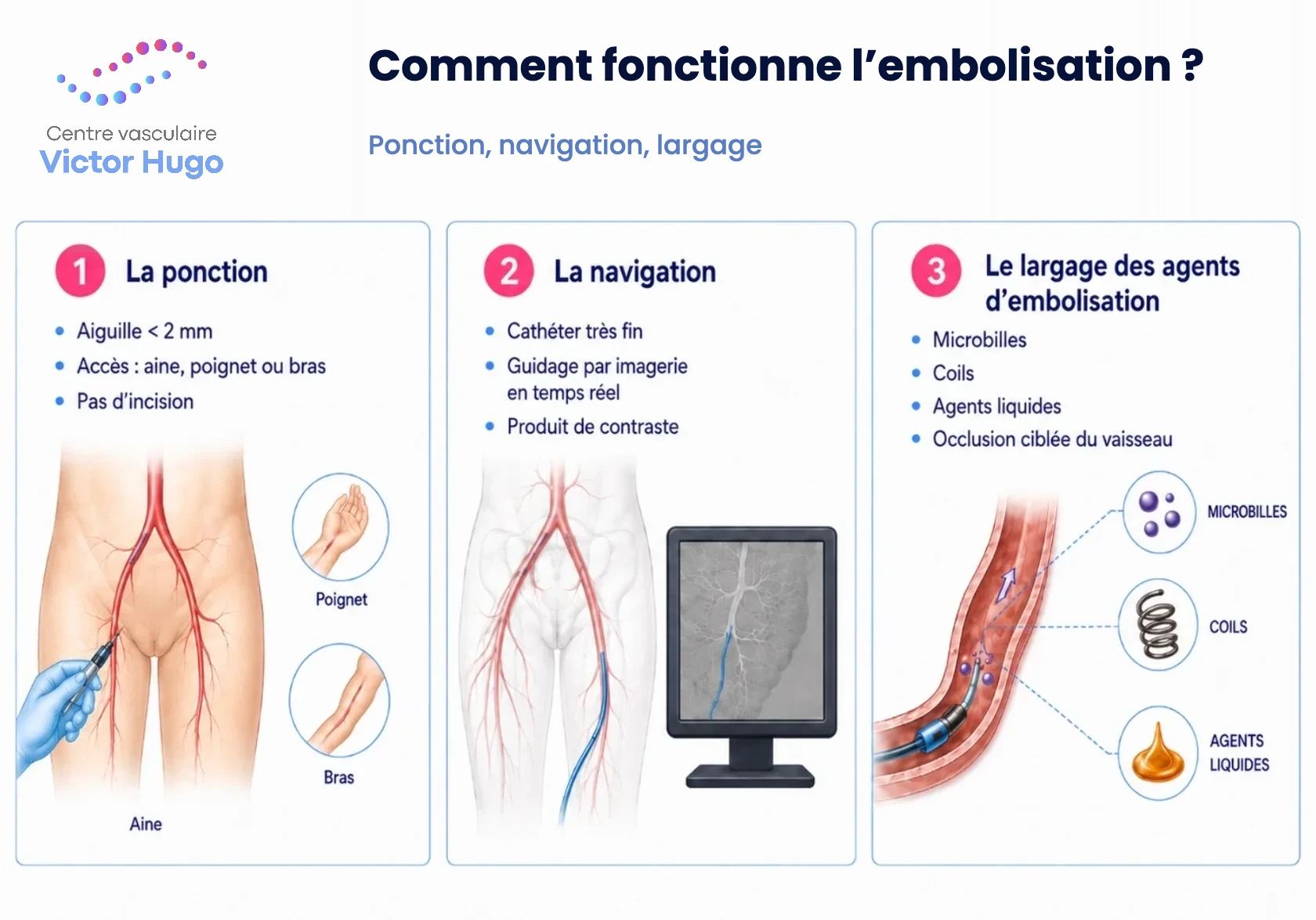 Les trois temps d'une embolisation : ponction au pli de l'aine, navigation du cathéter sous imagerie, largage des agents emboliques