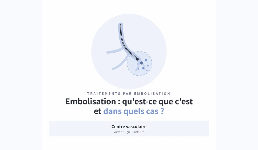 Embolisation : qu&rsquo;est-ce que c&rsquo;est et dans quels cas est-elle proposée ?