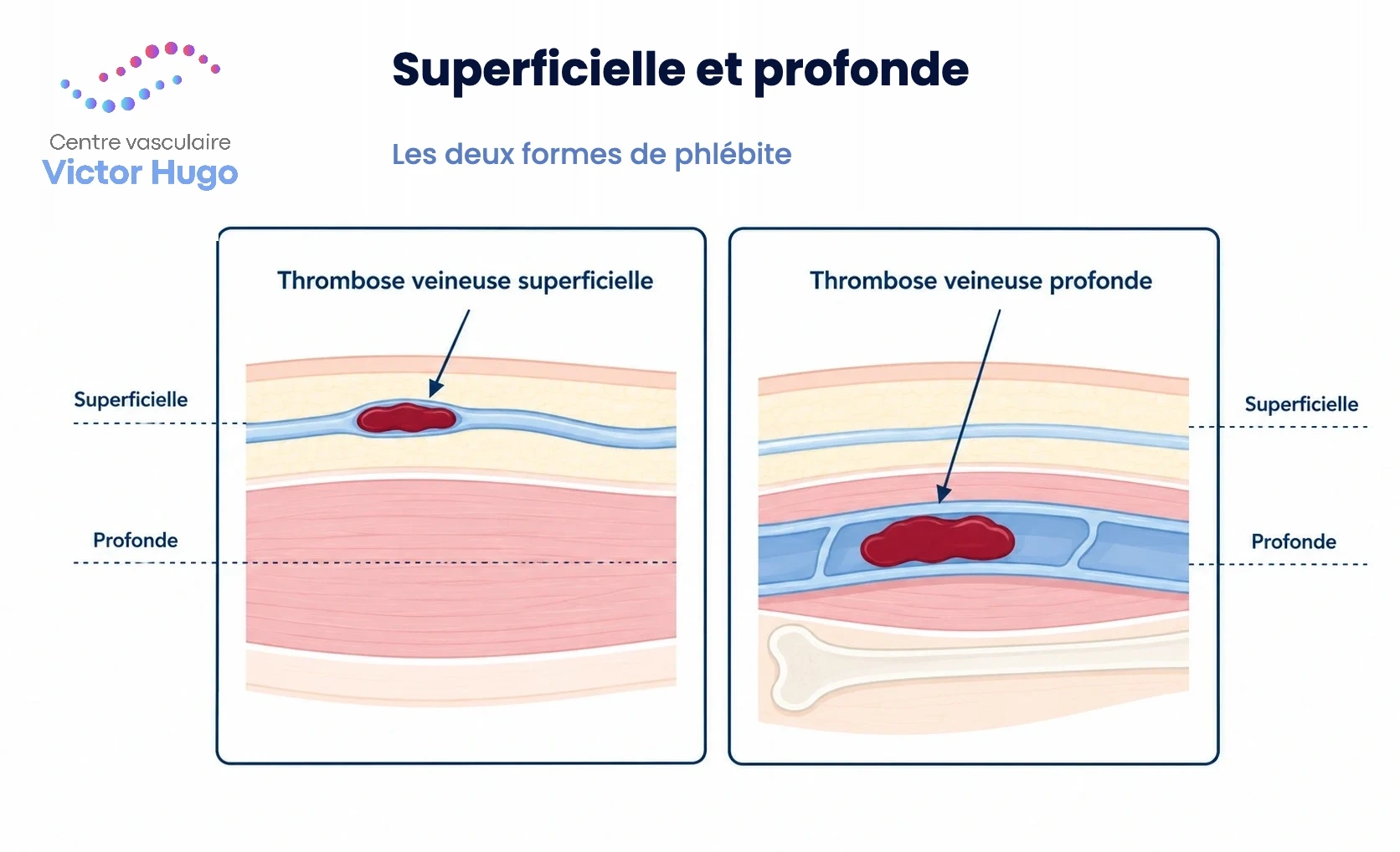 Schéma comparant une thrombose veineuse superficielle et une thrombose veineuse profonde dans la jambe